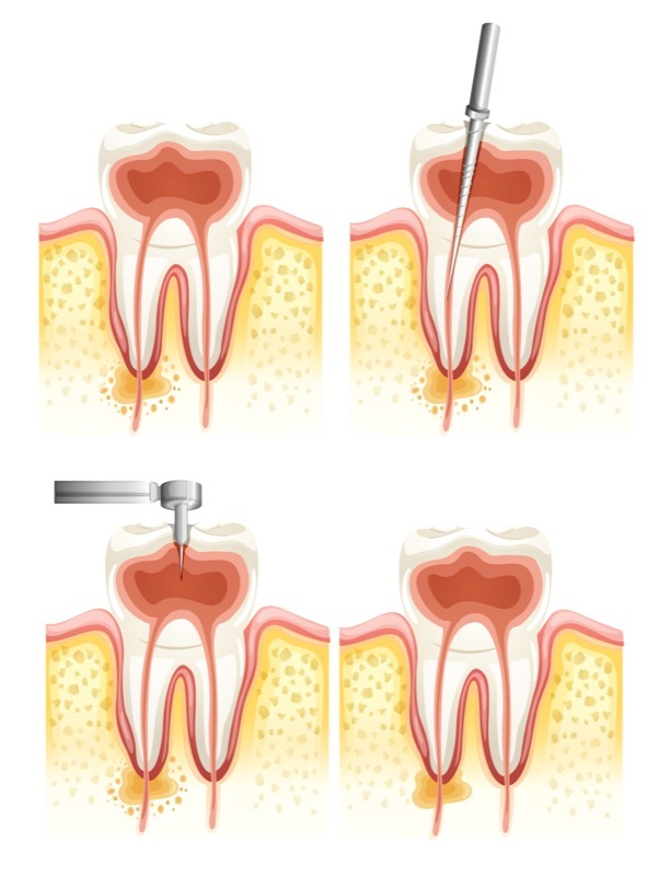 Durch eine erfolgreiche Endodontie kann der Zahn in den meisten Fällen erhalten bleiben